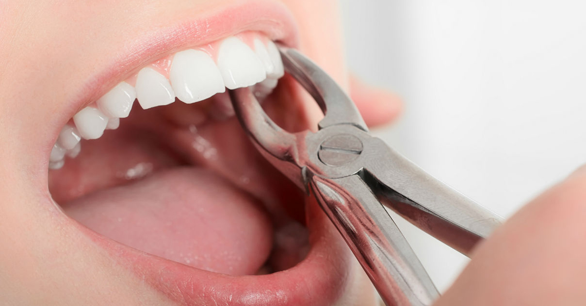 В каких случаях удаляют зубы?